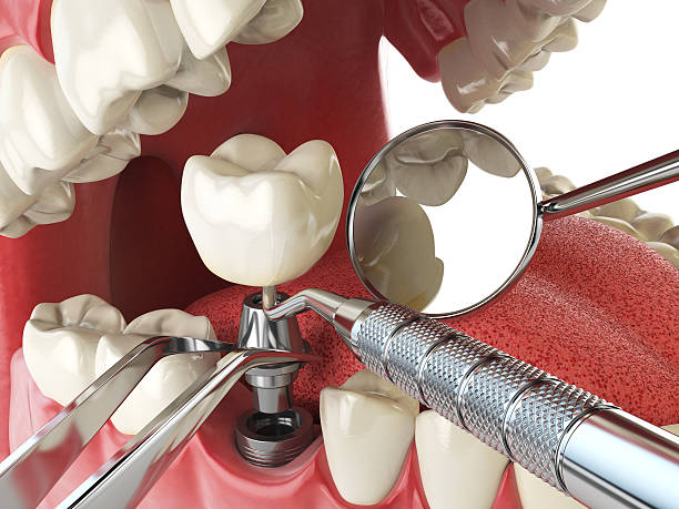 Best Lost Filling or Crown Replacement in Enid, OK